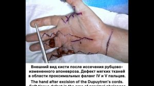Этапы хирургического лечения рецидива контрактуры Дюпюитрена после 5 субтотальных апоневрэктомий