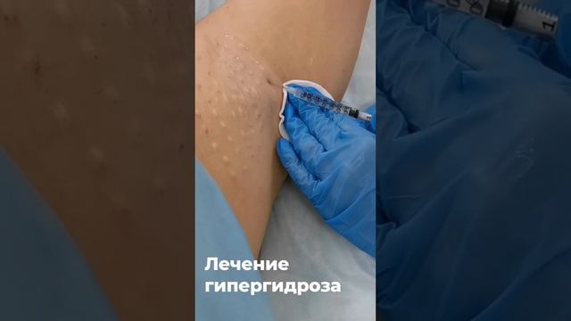 Лечение гипергидроза подмышек, лечение пота