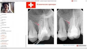 Простое решение в эндодонтии