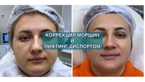 Диспорт FULL FACE для деформационно-отечного морфотипа старения
