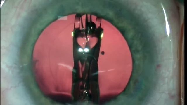 Bausch + Lomb Surgical: Implantation der LuxSmart - PD Dr. Hoerster I Erkelenz смотреть онлайн