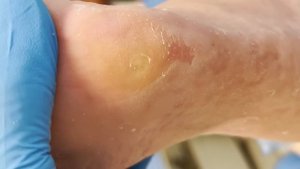 Large area of calluses on feet with nails hidden inside【Xue Yidao】