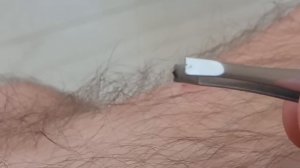 Как вытащить клеща пинцетом|Как быстро и безопасно вытянуть клеща из тела человека!