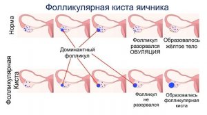 Фолликулярная киста яичника на УЗИ, что это