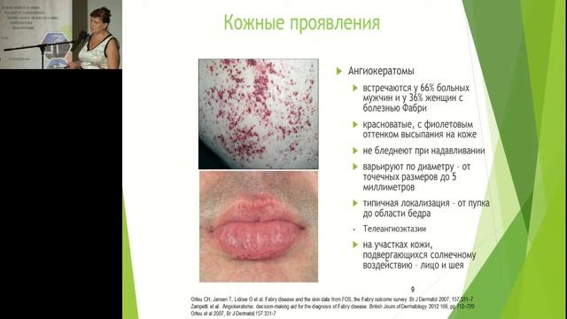 Агафонова О Хвороба Фабрі диференційна діагностика та лікування смотреть онлайн