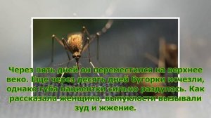 У россиянки после укуса комара под кожей поселился червь