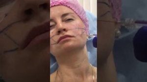 Коррекция лица .Belotero Soft , Belotero Volume.Не повторяйте моих ОШИБОК !