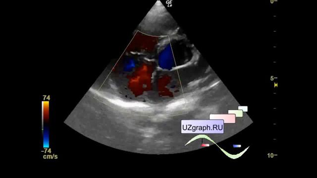 Детская эхокардиография - коронарная фистула смотреть онлайн
