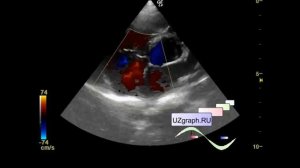 Детская эхокардиография - коронарная фистула