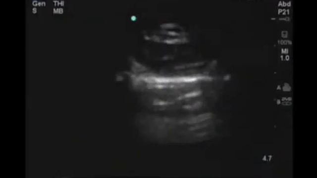 Порядок выполнения: ультразвуковая оценка пневмоторакса