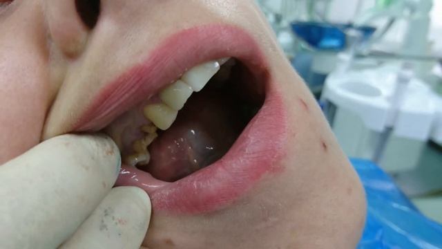 Протезирование металокерамикой. До и после протезирования. смотреть онлайн