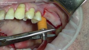 Доктор Шумовский Д.Б. Гидравлическое поднятие мембраны.