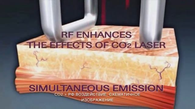 CO2 + РФ-лифтинг смотреть онлайн