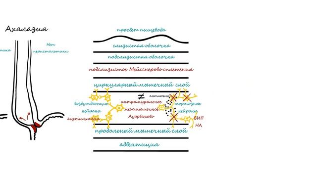 Ахалазия кардии смотреть онлайн