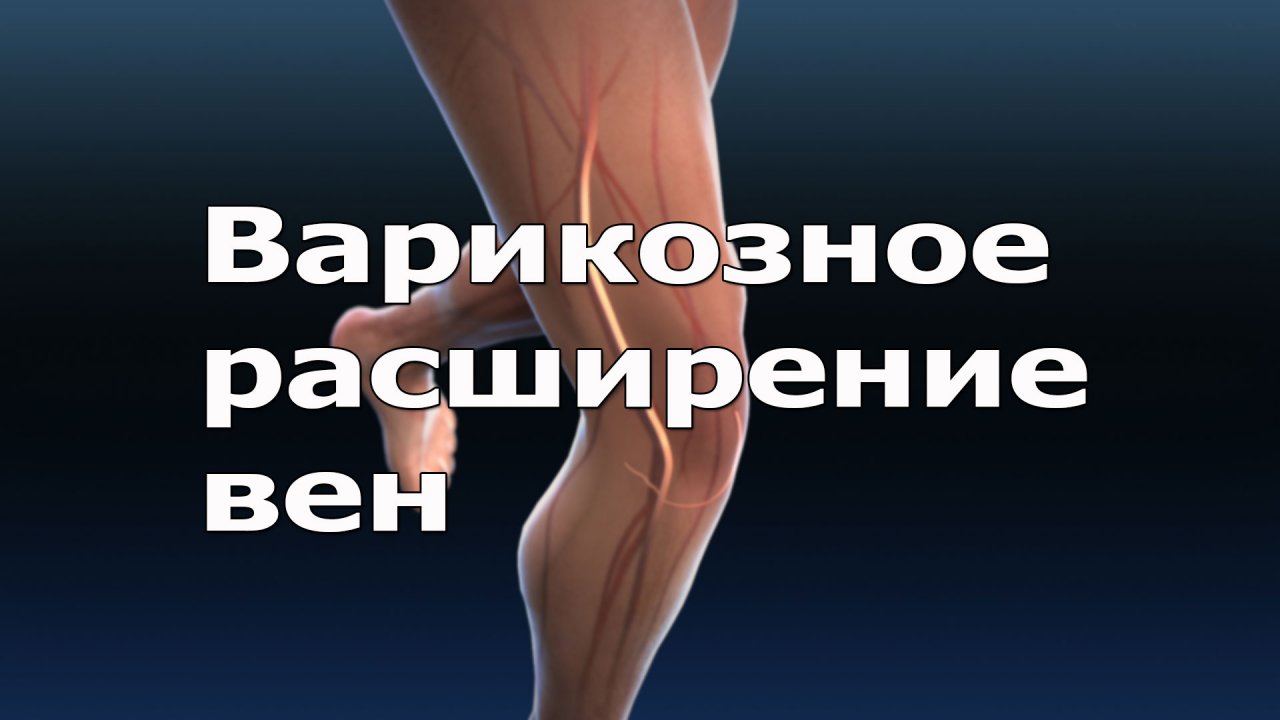 Варикозное расширение вен Как лечить варикоз (720p).mp4