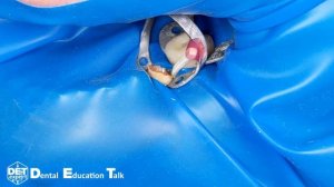 Изоляция корня 35 для преэндодонтического билдапа кламп B4 с клинышком  DET.expert & Sanctuary 4K