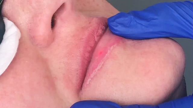 Лазерное удаление татуажа губ смотреть онлайн