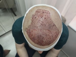 Двухдневная сессия: пересадка 3200 графтов.
