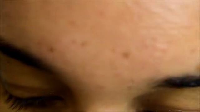 Blackhead Remover Pimple Extractor Tool Acne Removal Kit смотреть онлайн