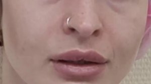 АирисКом студенты учатся: удаление филлера на губах.