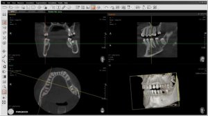 Возможности программы Ez3D: замеры на КЛКТ