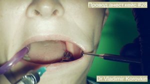 Проводниковая анестезия для лечения 37 .Кейс # 28.