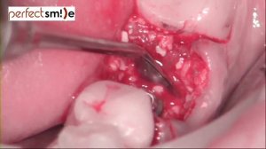 Immediate dental implant placement plus Osteobiol MP3 graft + CTG