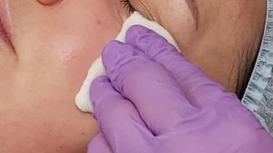 Мезотерапия. Инъекции при темных кругах под глазами.