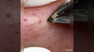 How to remove black head on nose#acne treatment