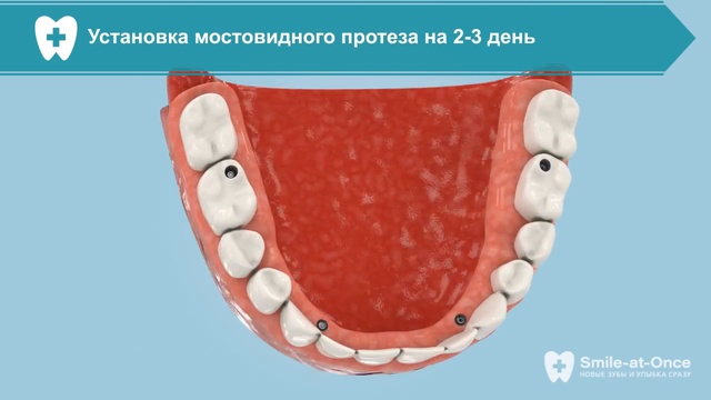 Протезирование зубов All-ON-4