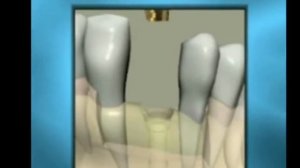 Имплантация зубов в Хэйхэ