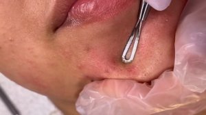 Вросший Волос, Прыщи! Как Ты Любишь!