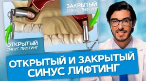 Открытый и закрытый синус лифтинг. В чем разница между открытым и закрытым синус лифтингом?