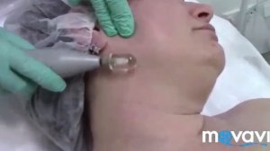 Процедура на аппарате Шарм.