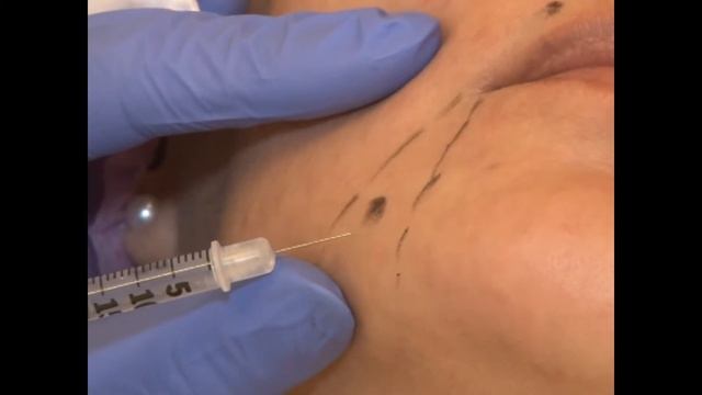 Нет морщинкам!! смотреть онлайн