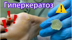 Гиперкератоз ??⚠️❗️?