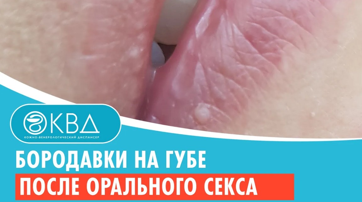 ? Бородавки на губе после орального секса. Клинический случай №646