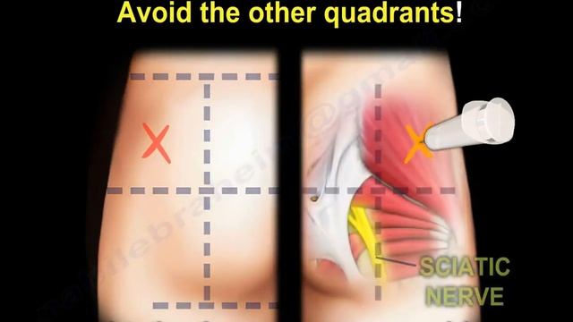 Glute injection - Everything You Need To Know - Dr. Nabil Ebraheim ...