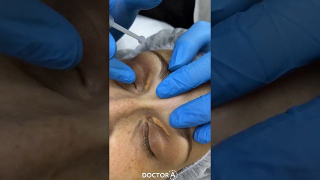 Лазерное удаление ксантелазм! До и сразу после удаления! смотреть онлайн