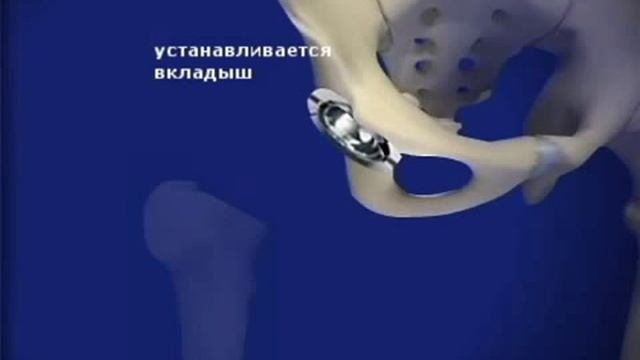 эндопротезирование тазобедренного сустава.flv