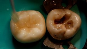 реставрация жевательного зуба