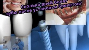 Сколько дней болят зубы после установки брекетов?