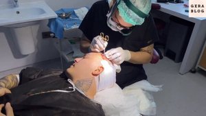 ПЕРЕСАДКА ВОЛОС. Результат ДО и ПОСЛЕ. Стамбул?