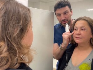 Верхняя и нижняя блефаропластика: неделя после операции.