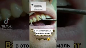 Пришеечный кариес!!!