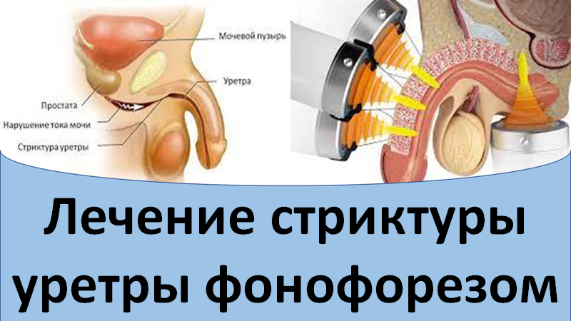 Лечение стриктуры уретры фонофорезом