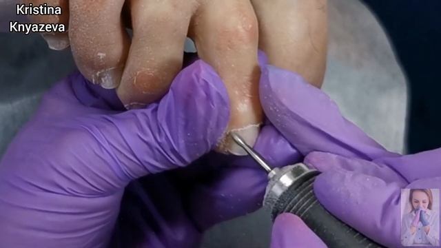 75+❤️ПЕДИКЮР НА СЛОЖНЫХ НОЖКАХ?Как отодвинуть ПРИЛИПШУЮ КУТИКУЛУ⁉️Чистый педикюр ? смотреть онлайн