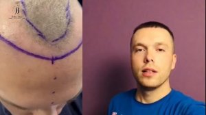 Результат пересадки волос / Hair transplant result