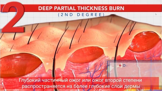 Лечение различных типов ожогов с помощью Burnshield смотреть онлайн
