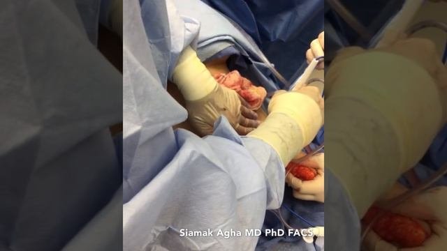 Tummy Tuck